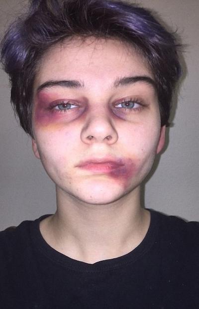 Boy with black eye and bruises on his face